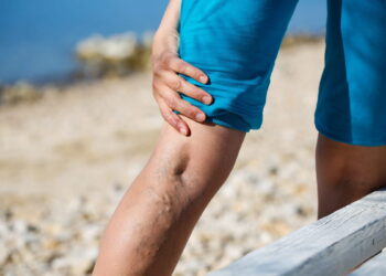 ما هو علاج الدوالي و علاج دوالى الساقين نهائيا؟ 1 ما هو علاج الدوالي و علاج دوالى الساقين نهائيا؟